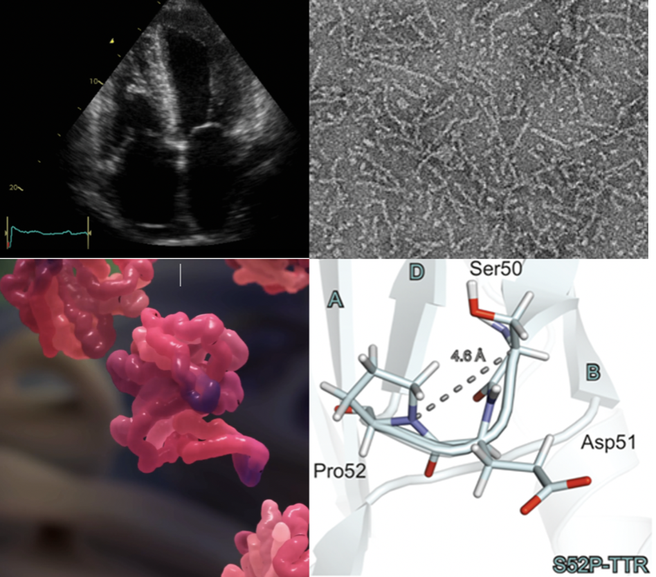 Heart and Mind workshop highlights challenges and ways ahead for amyloid research