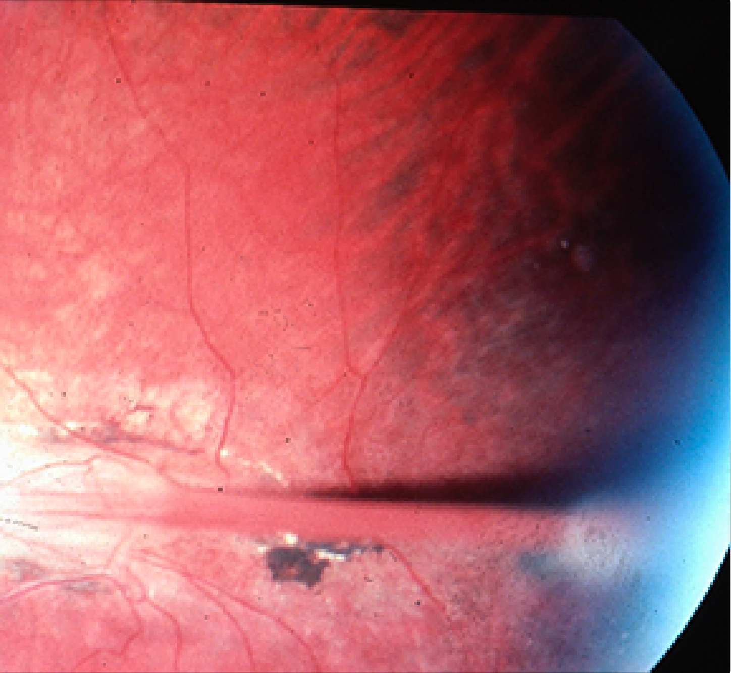 Blood Rop Retinopathy of Prematurity (ROP) — Beautiful Vision Project