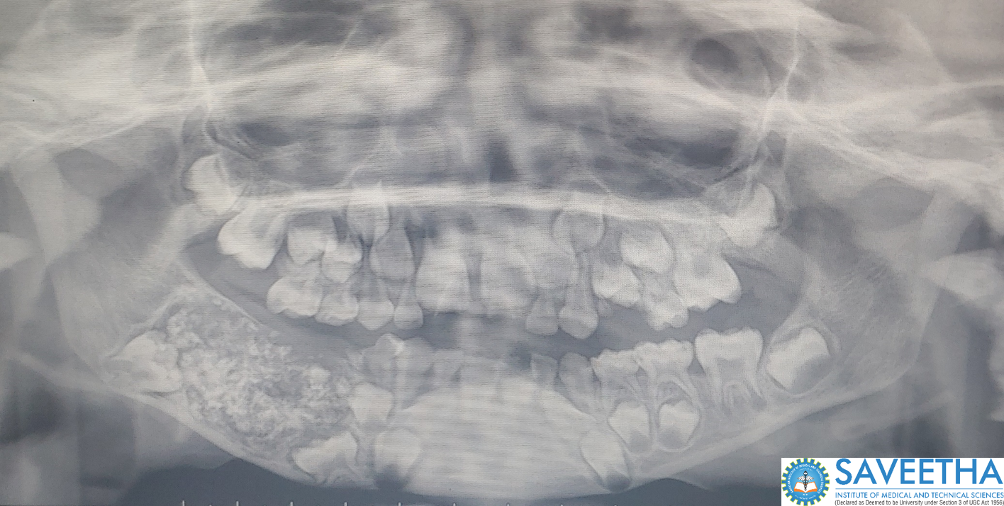 OPG: Reveals Mixed Radiolucent -Radioopaque structure in the right side of the lower jaw