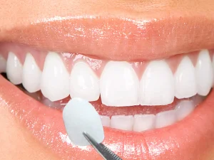 Porcelain-Veneers.jpg