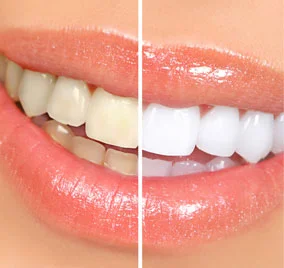 tooth_whitening.jpg