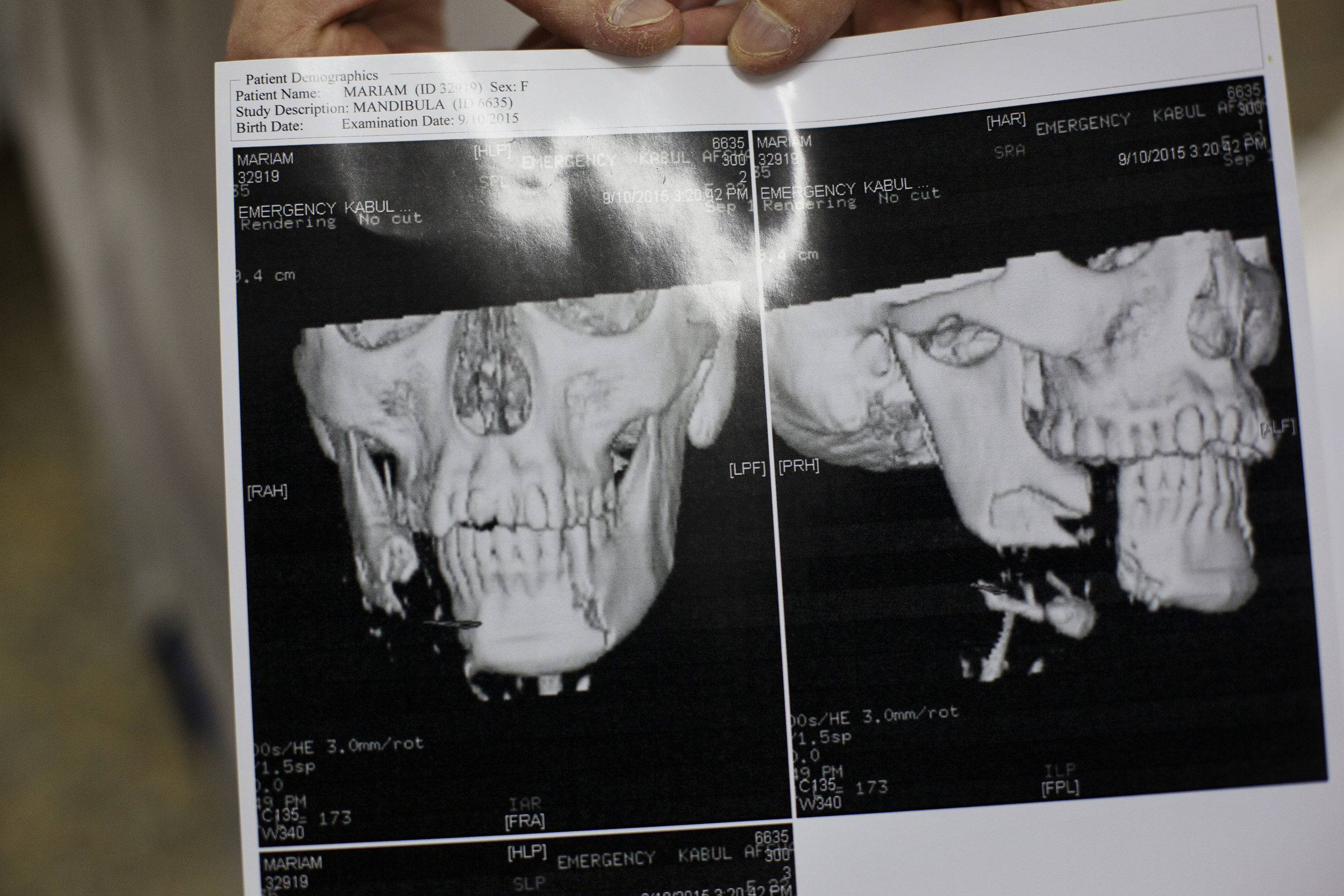  A CAT scan of Maryam, 22, from Ghazni. 