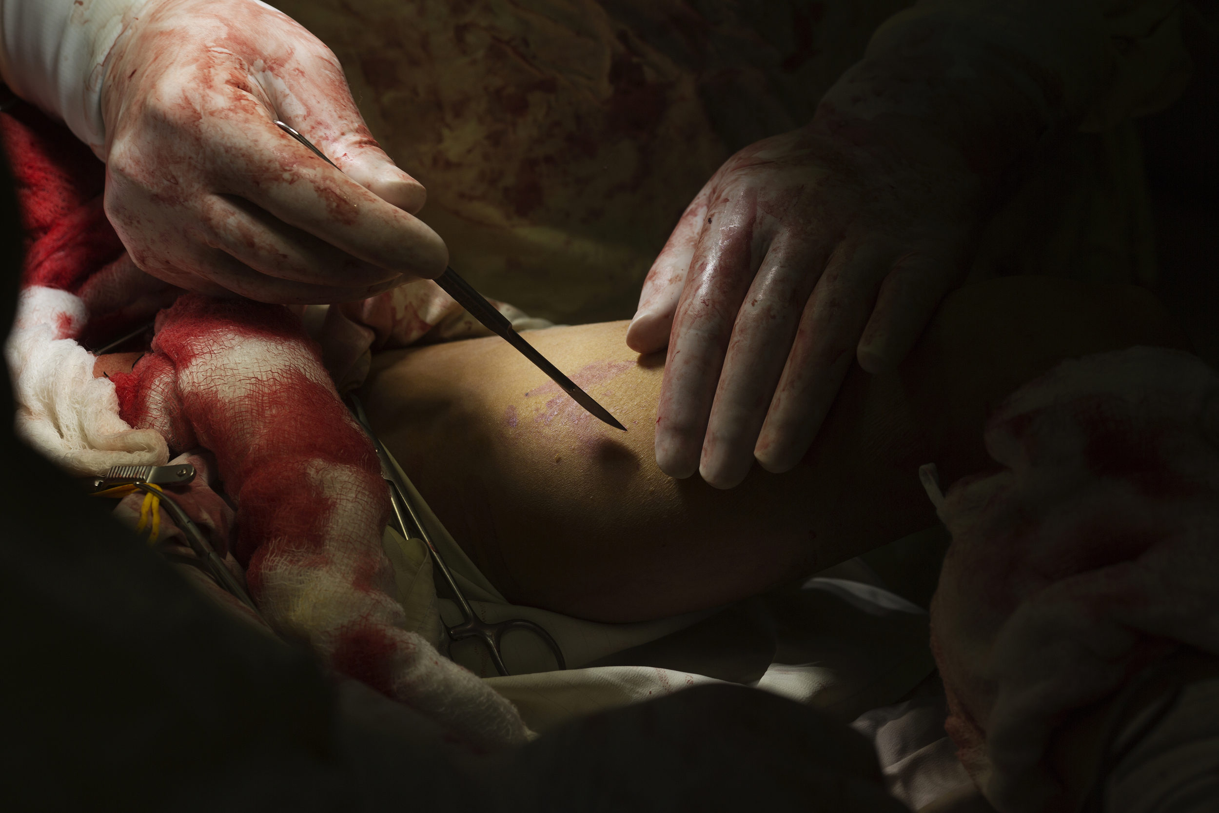  Dr. Shukur Sardar prepares to open the thigh of Jan Mohammed, 10, to extract a vein for a vascular graft, after he suffered multiple blast injuries from an unexploded munition. 
