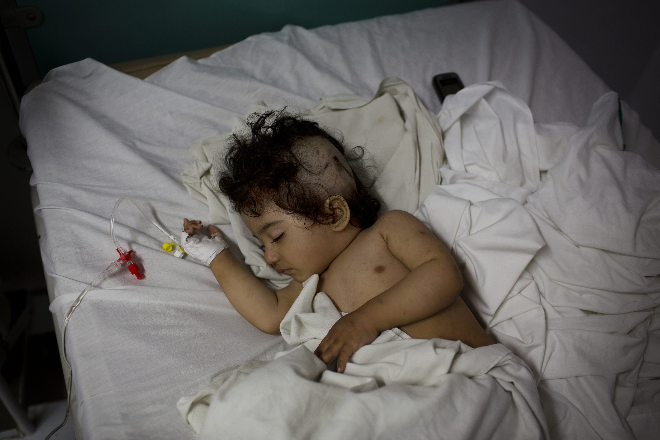  Nasirullah, 1, who suffered a shrapnel injury to her head,&nbsp;sleeps in the sub-ICU. 