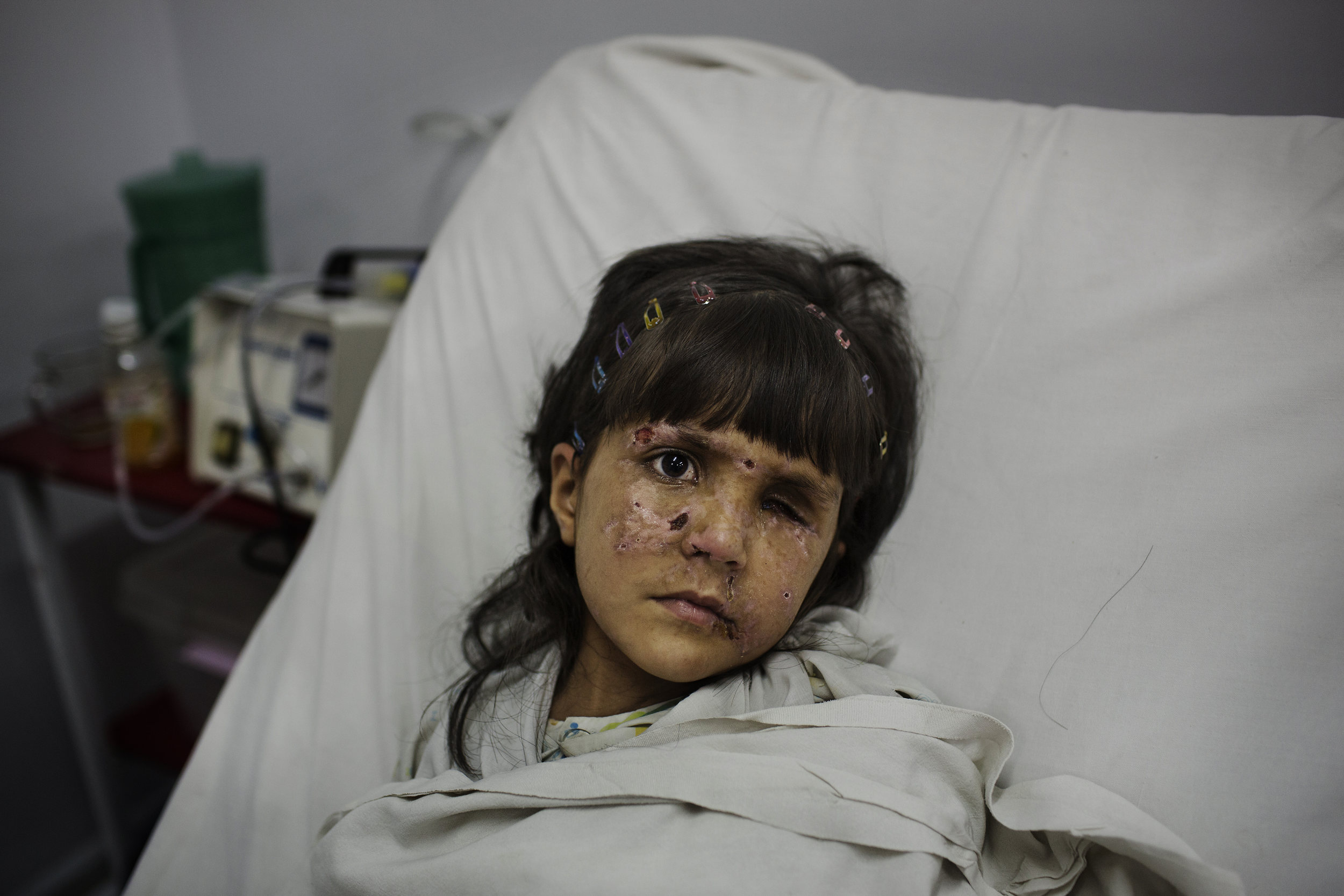  Maneza, 5, from Gardez, recovers from a mine explosion that cost her hand and right eye. 