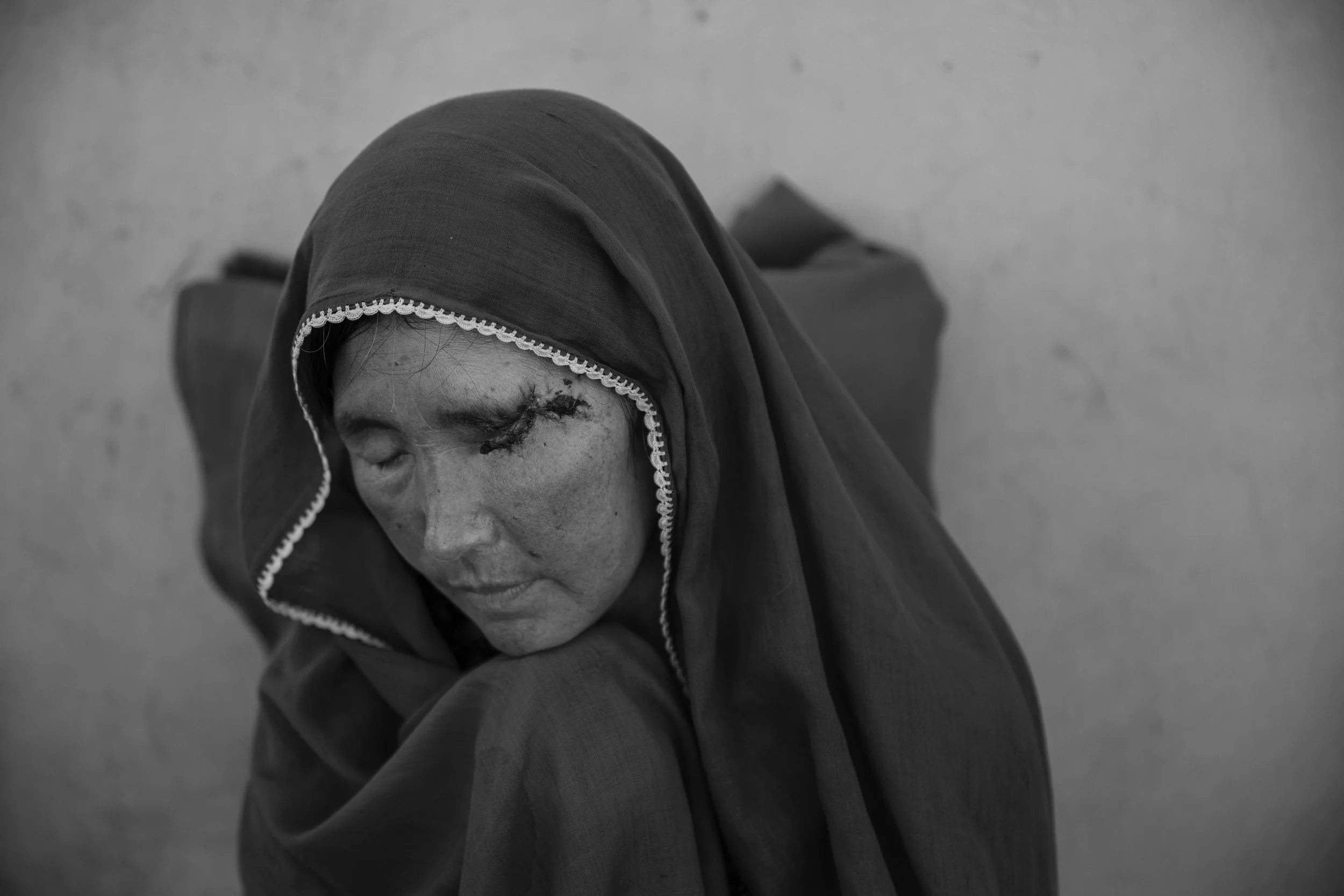  Wazir Nazary, 40, shot in the face by Taliban assailants. 