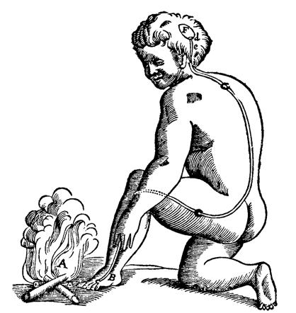 Figure 1 . Descartes (1890) original linear theory of pain being triggered by putting foot in fire then literally ringing a 'pain bell' in the brain as it is received from the tissues. We now know this linear uncomplicated system to be highly inaccurate.