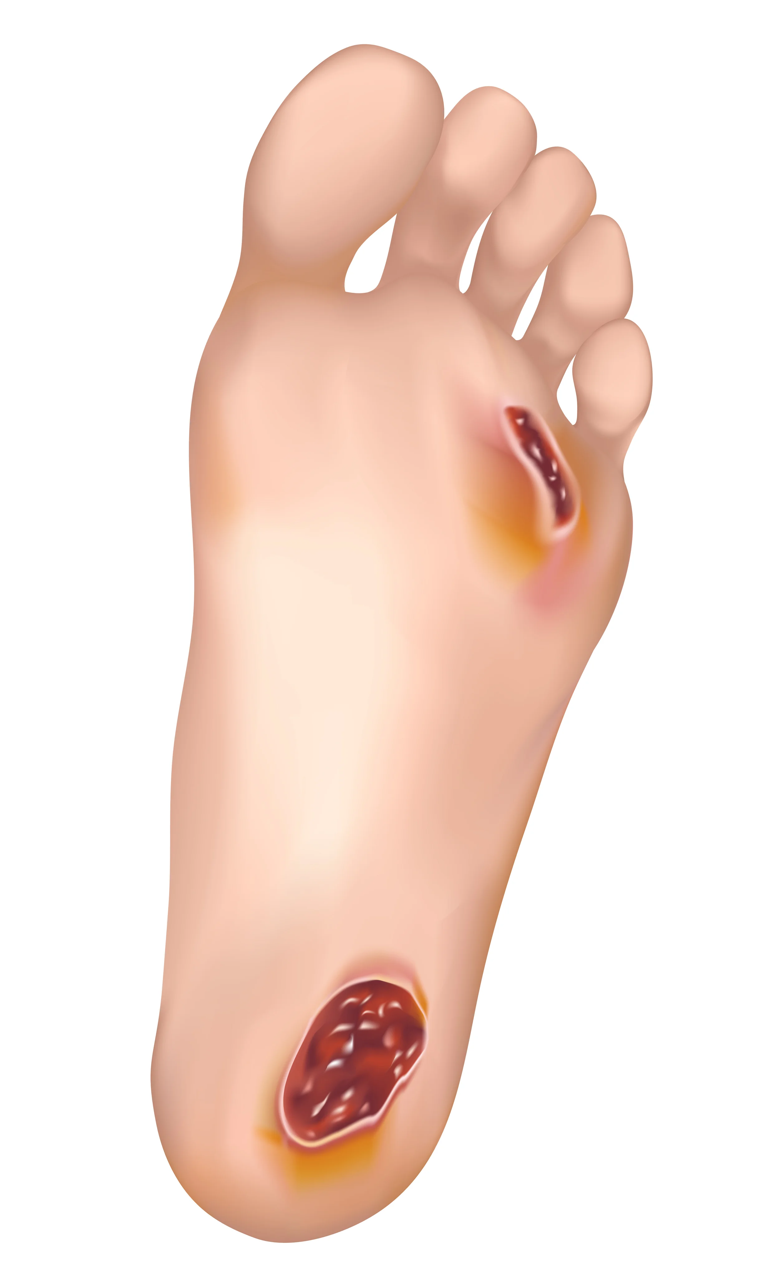 Diabetic Foot & Wound Care — Advanced Foot and Ankle Care PC
