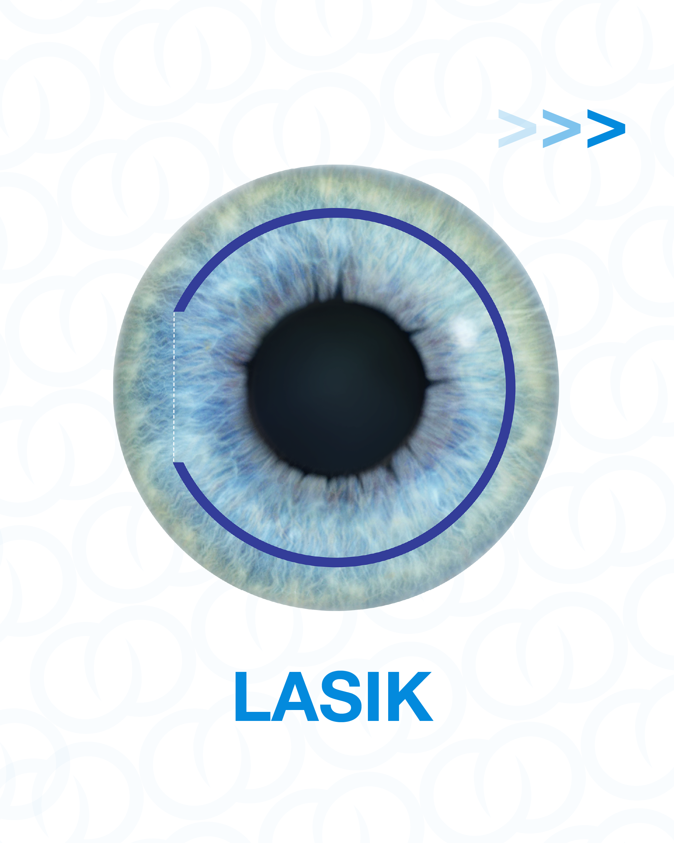 FY&E-Post-KnowYourOptions-LASIK.png