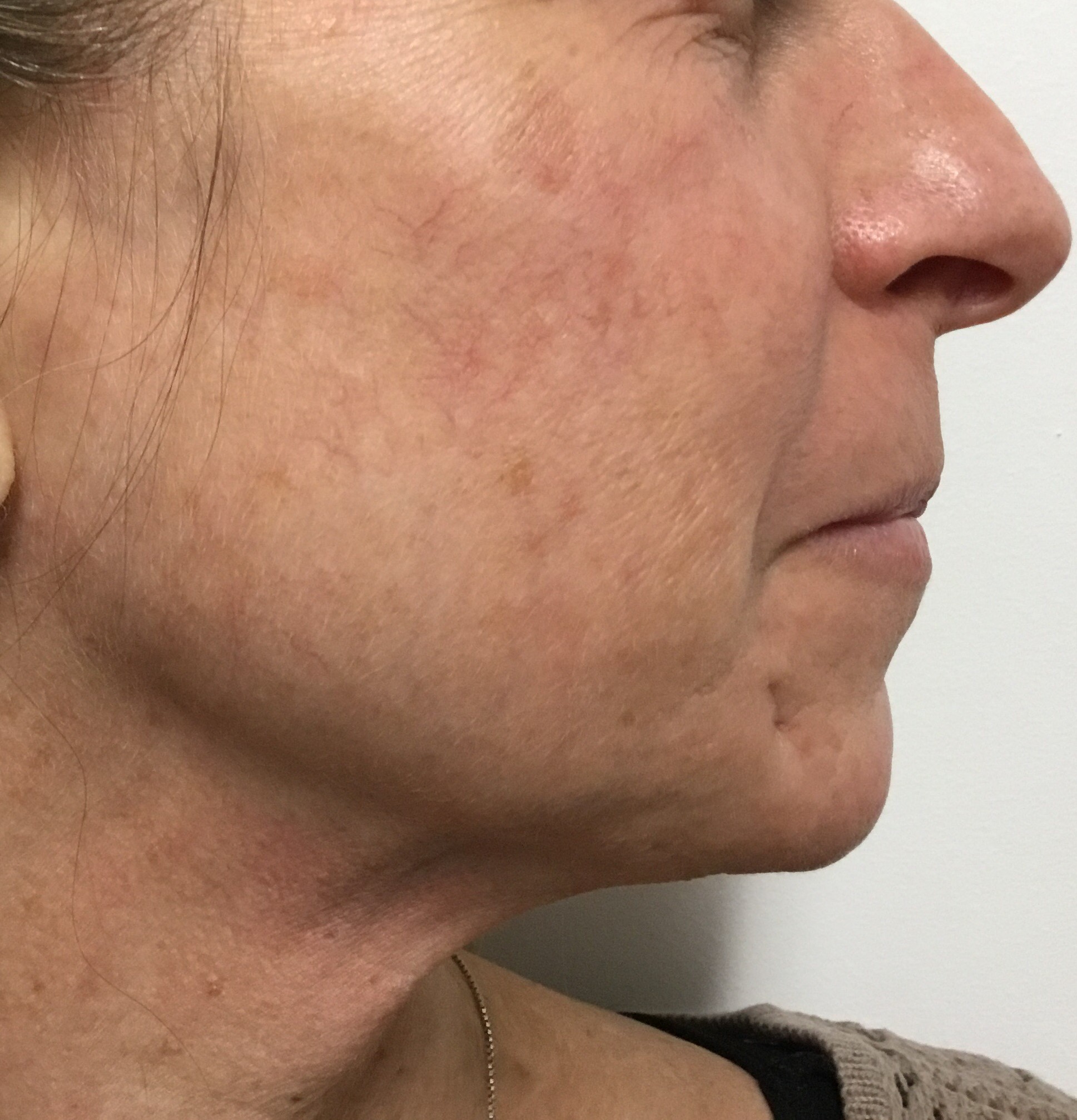 After: 1 VBeam treatment (normally needs 2-3 treatments) 
