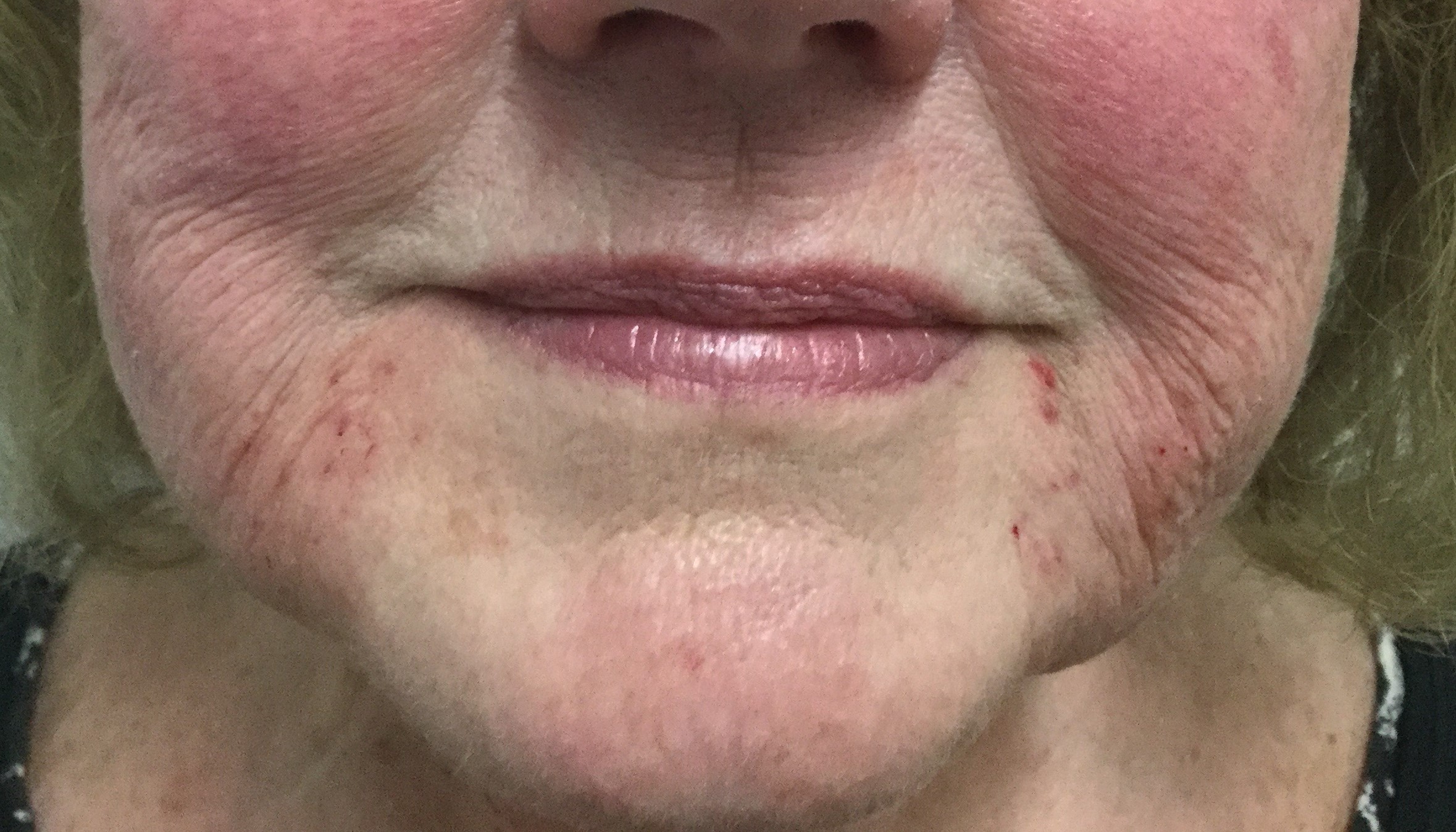 After: 2 syringes of Restylane Lyft 