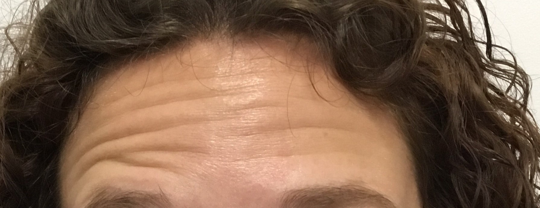 Before: Frontalis (forehead muscle) movement