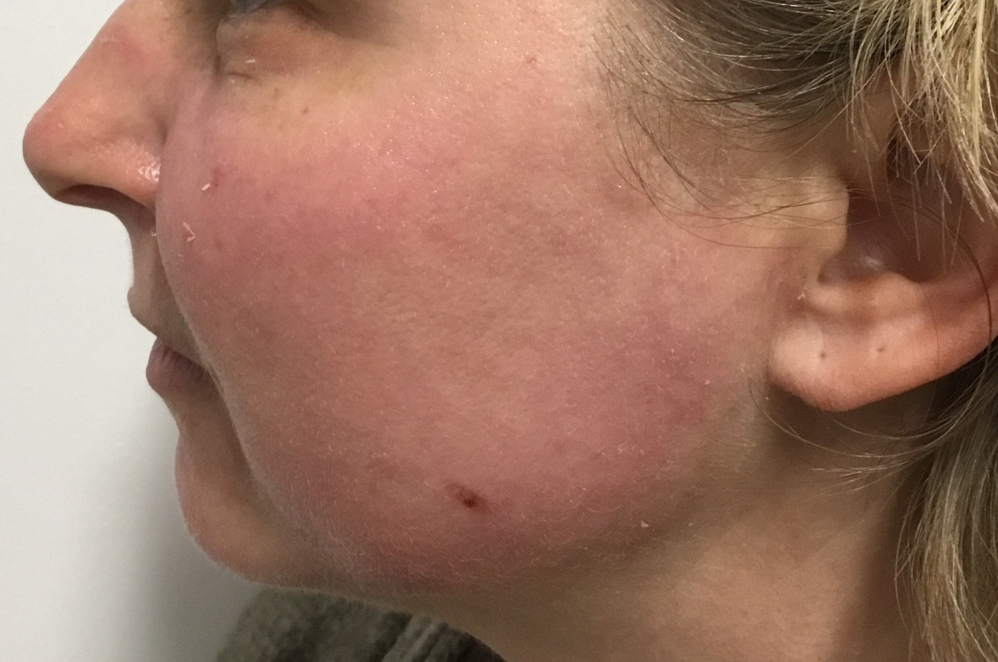 After: 8 days post medium depth peel