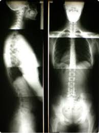 Full Spine X-rays