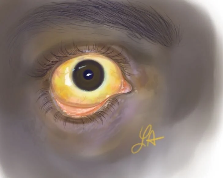 jaundice.jpg