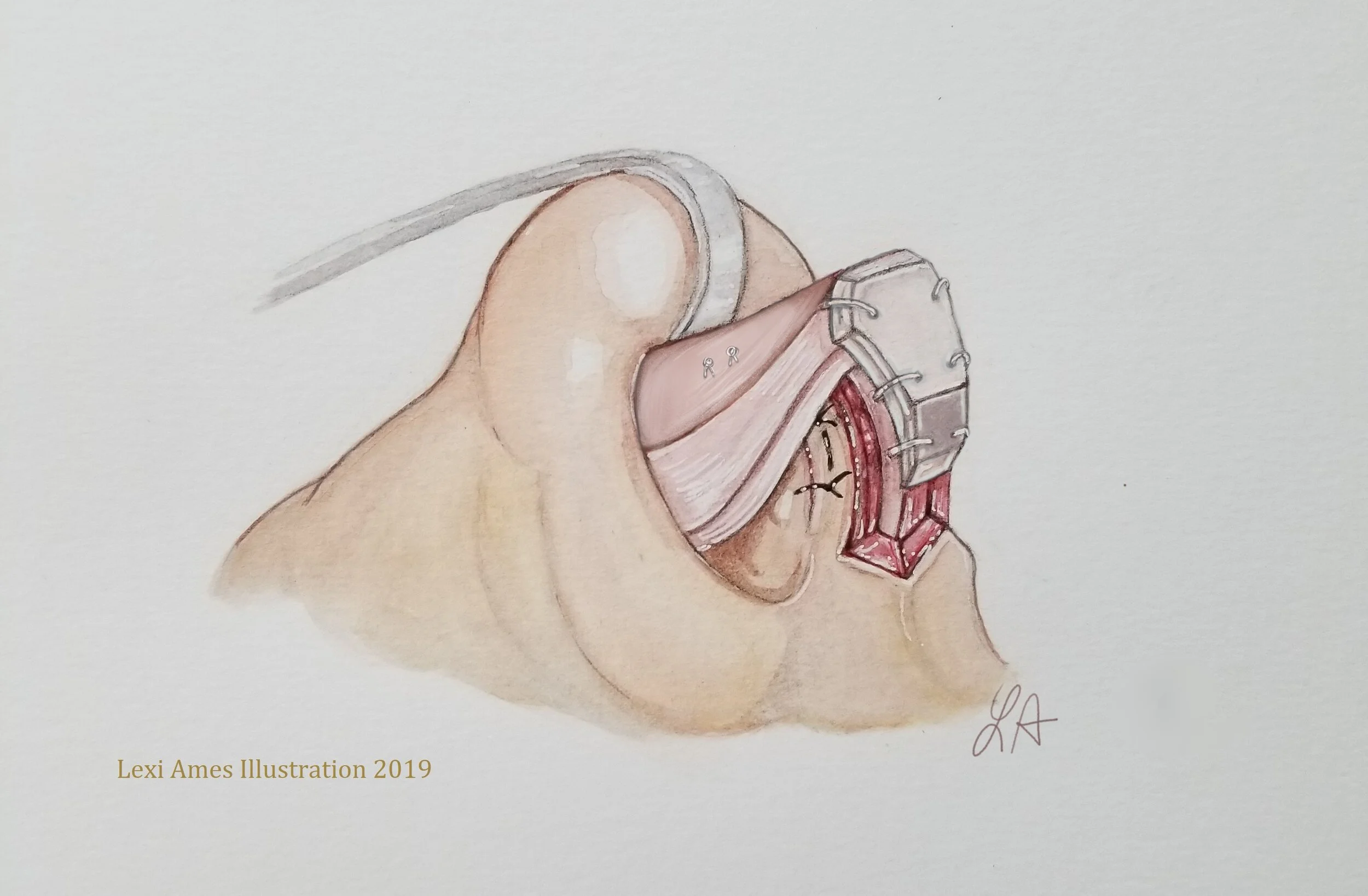 Ames-Gruber Tip Graft .jpg