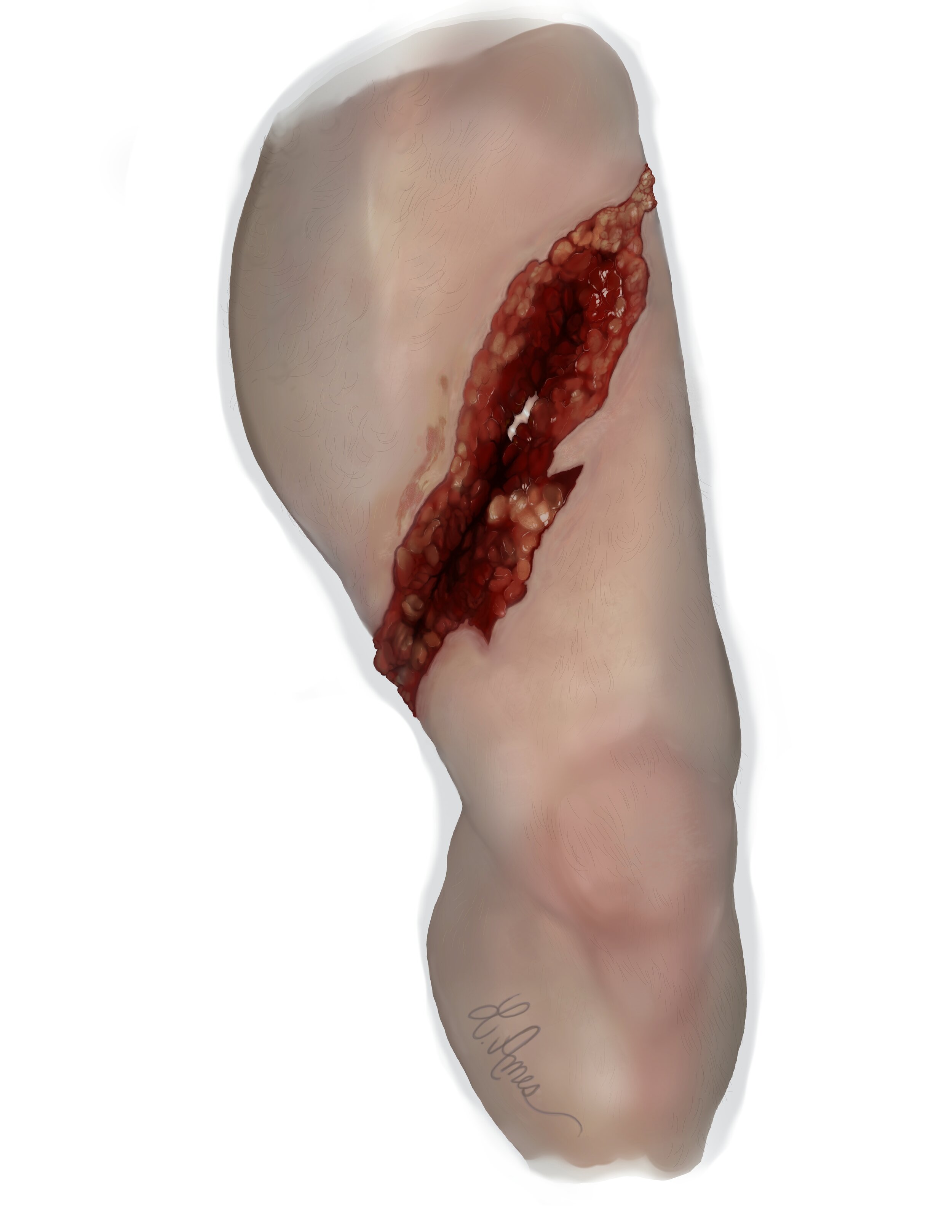 Thigh Laceration.jpg