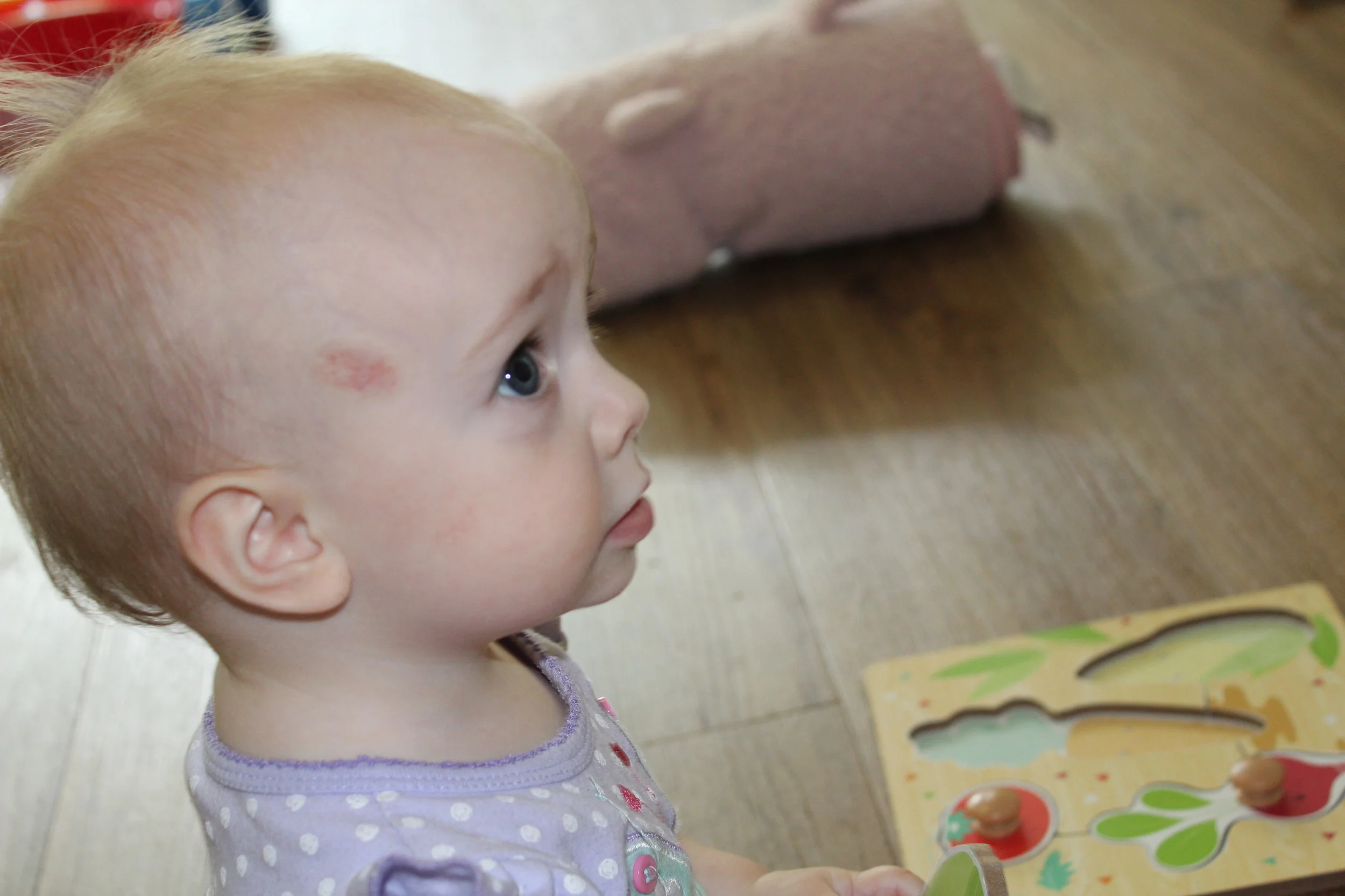 Amelia upon conclusion of using Propranolol for 7 months. 