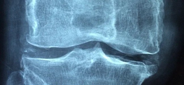 Osteoarthritis Treatment Options - Pain Relief &amp; Joint Health