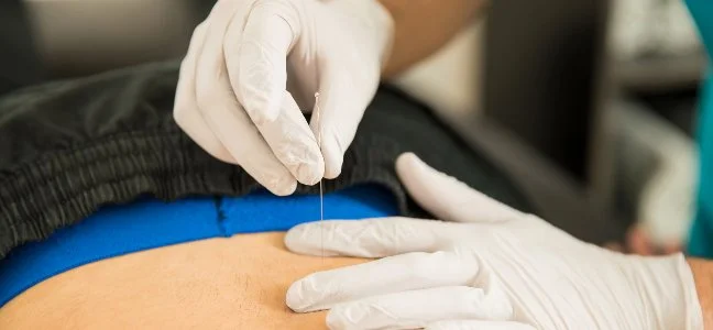 How Chiropractors Integrate Dry Needling for Optimal Pain Management