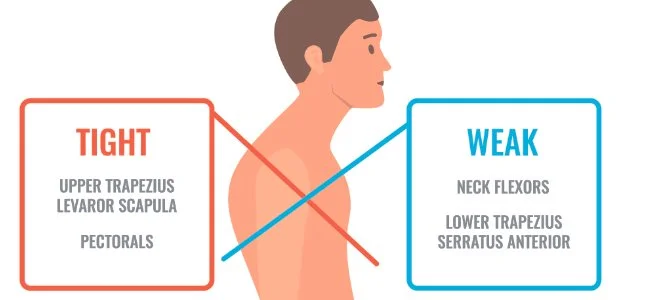 Understanding Upper Crossed Syndrome: Causes, Symptoms &amp; Effective Solutions