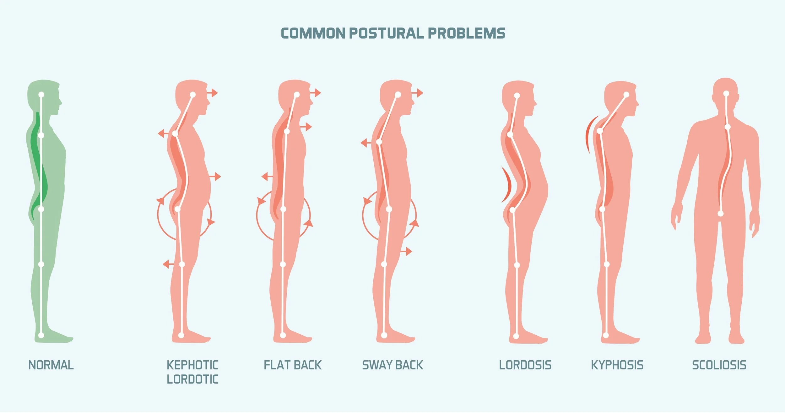 Common Postural Issues.jpg