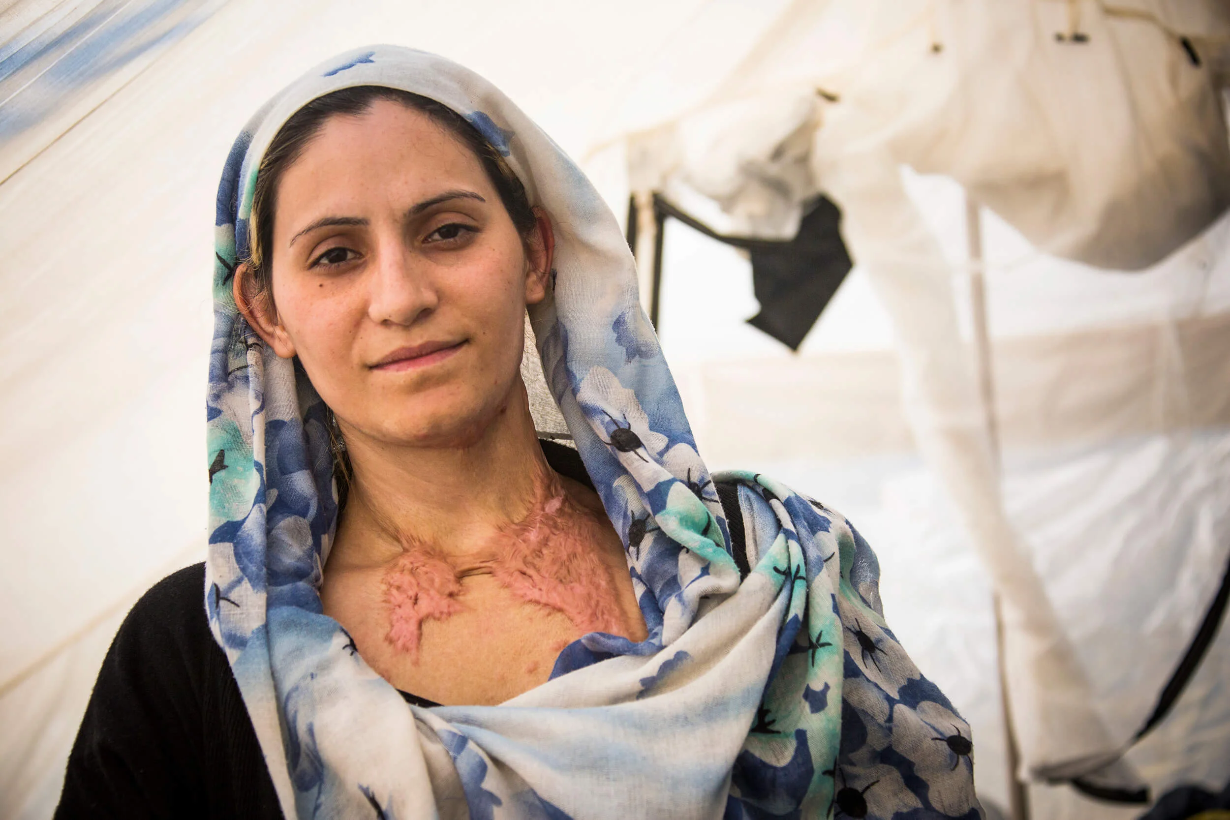 Serbia. October 2015. Mitra Jelali, från Afghanistan seriously injured by a grenade that hit her house, at the Serbian/Croatian border.