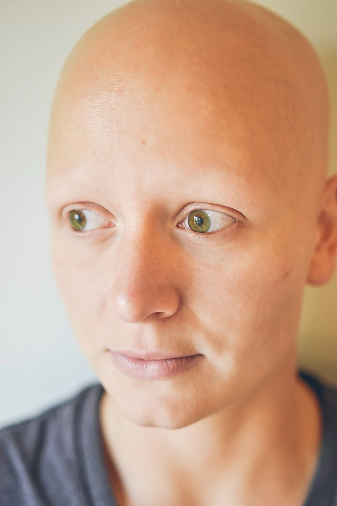 Michelle was diagnosed with alopecia at the age of 18, as she started losing hair very rapidly.