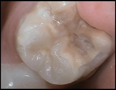 Hypoplasia on erupting six year molar