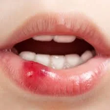 Lip bite2.jpg