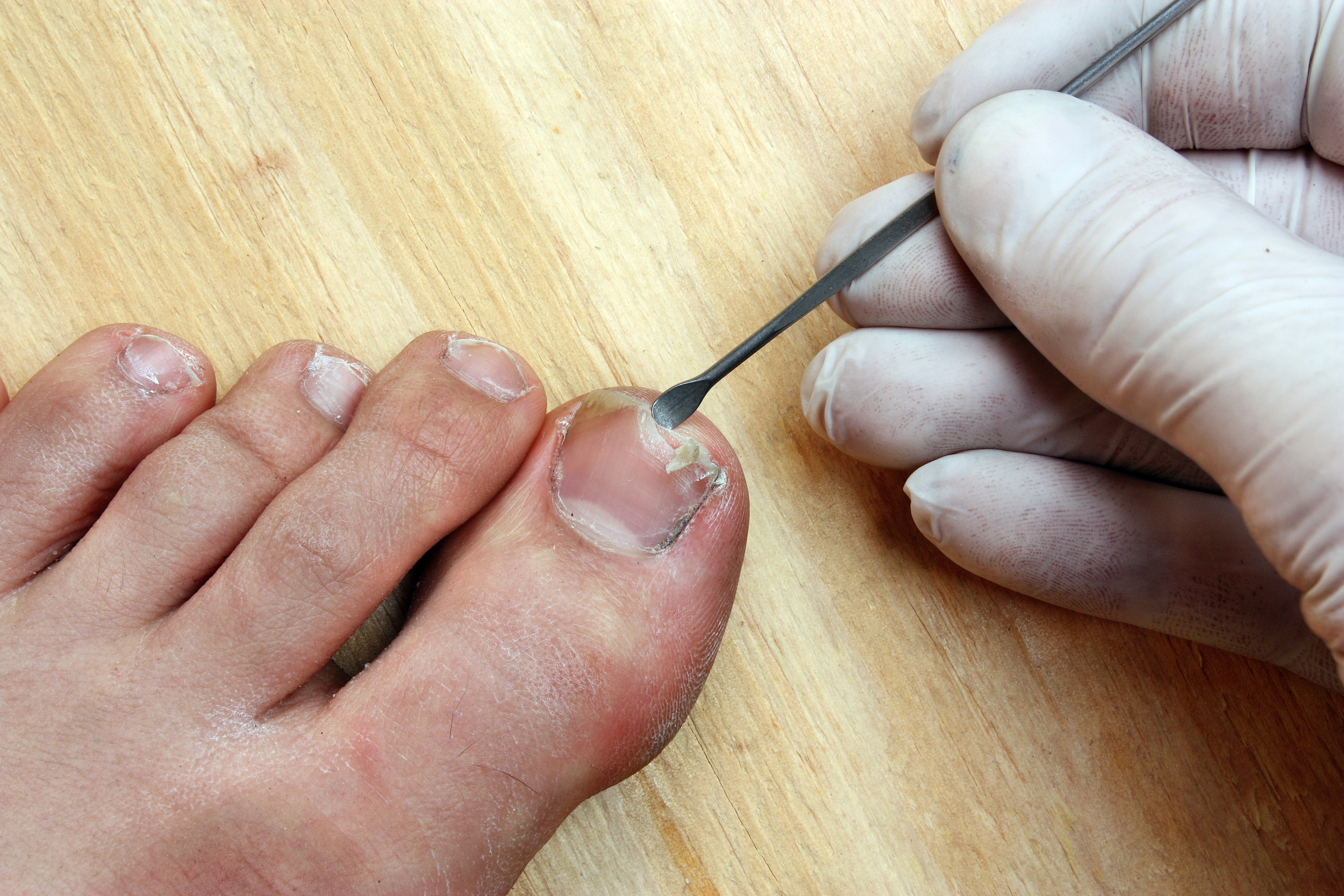 Ingrown toenails — Haag Foot & Ankle