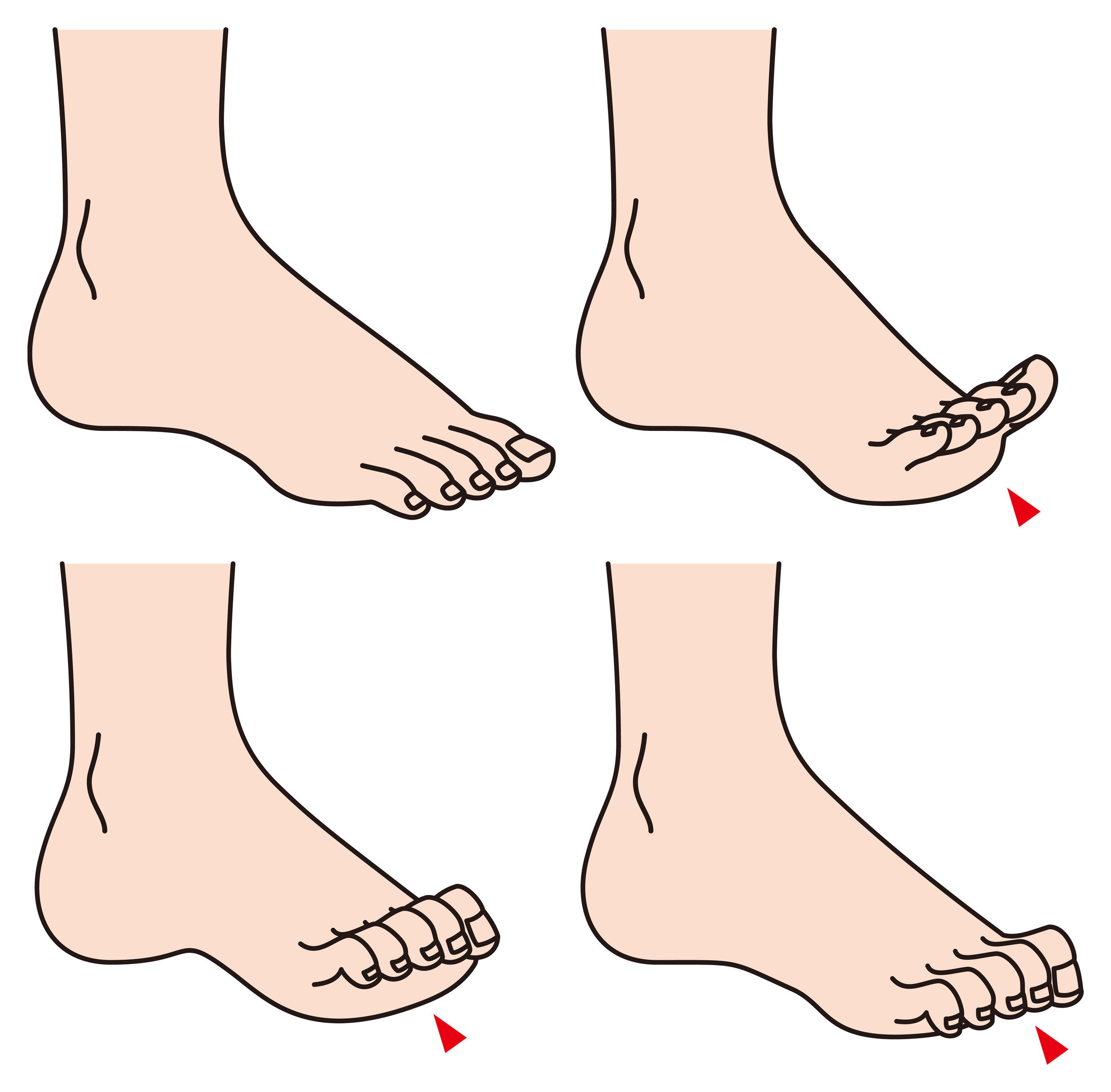 Hammertoes — Haag Foot & Ankle
