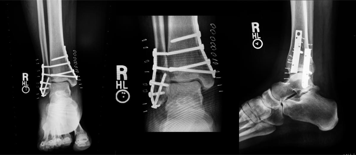 Yes, this is my ankle. No, it doesn't set off metal detectors.