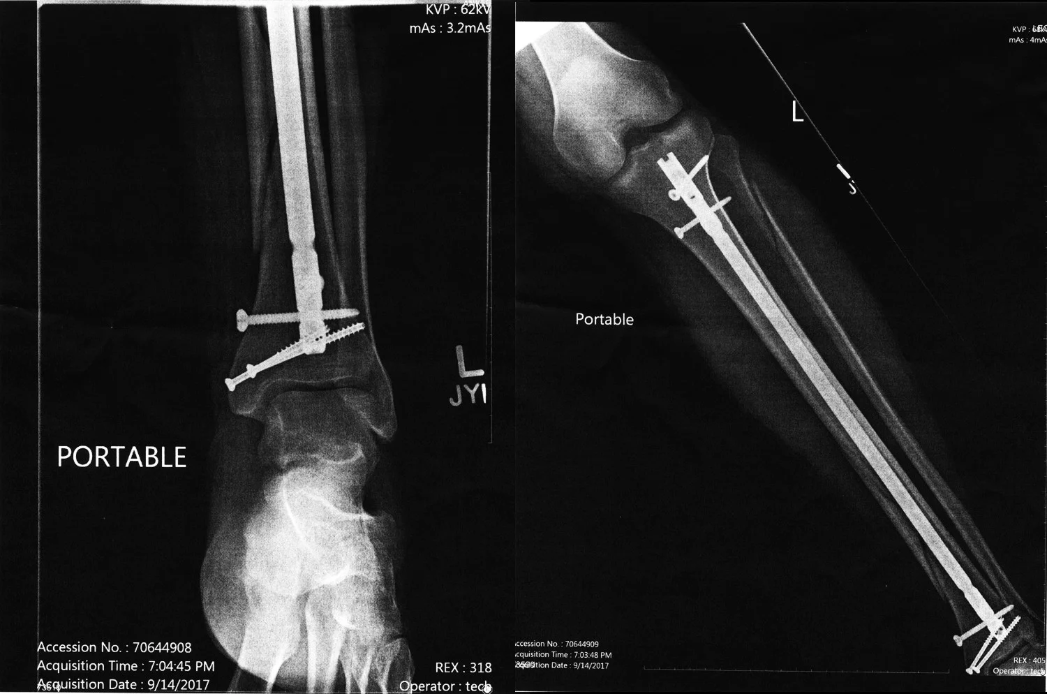 Left leg, post-op, September 2017.