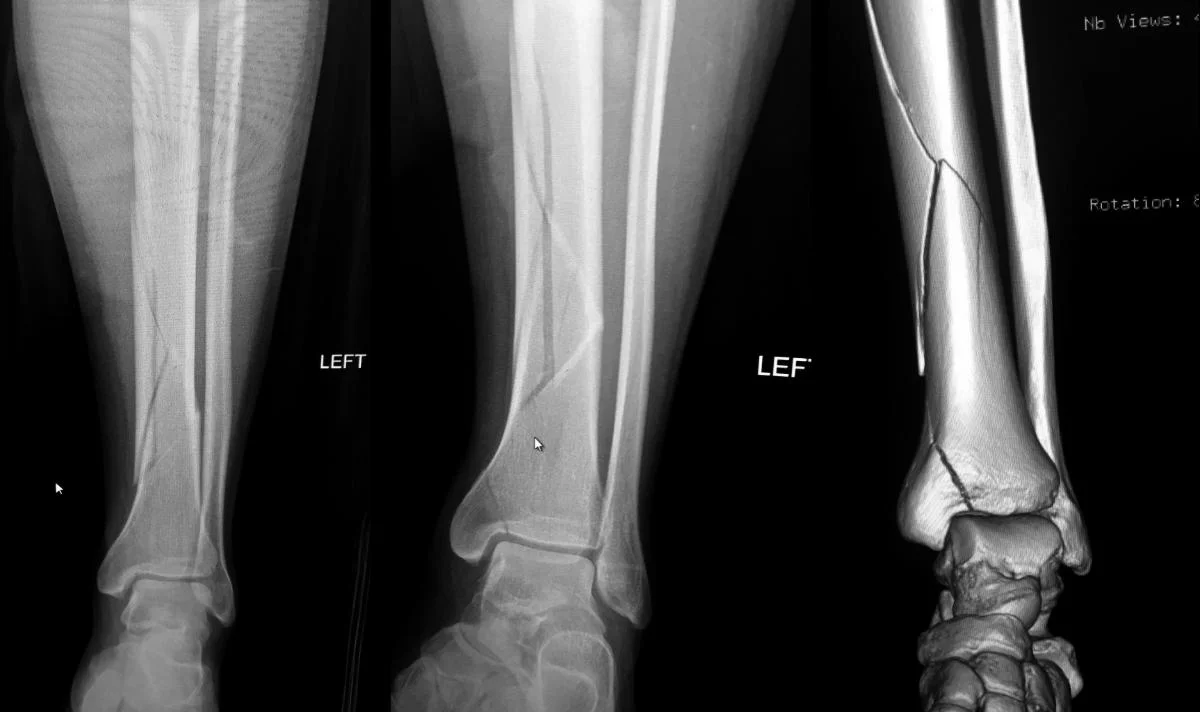 Left leg, pre-op, September 2017.