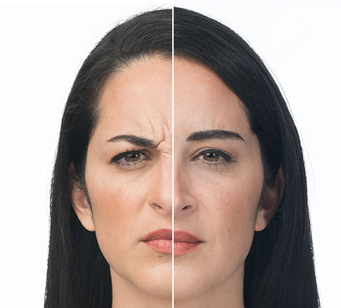 Copy of Neurotoxin Injections (Dysport, Emervel, Belotero, Botox)