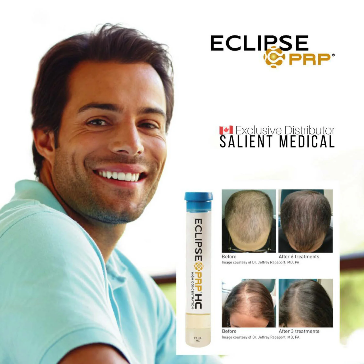 PLATLET RICH PLASMA (PRP)