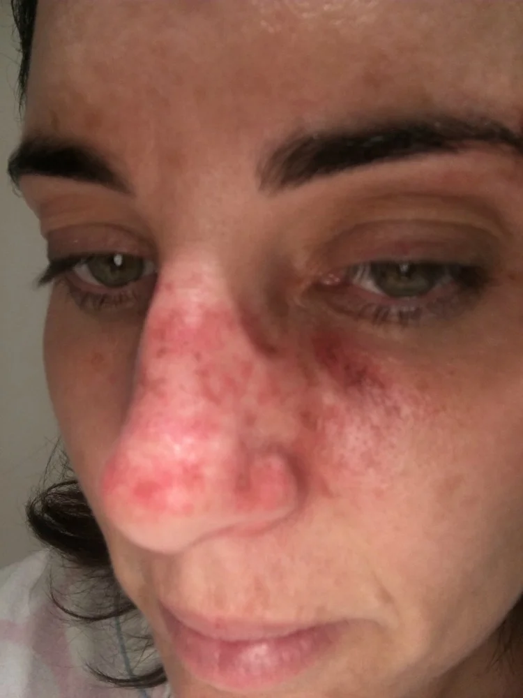 Cancer Face Nose PM.jpg