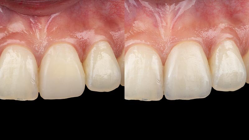 Composite (left) vs. Porcelain veneer (right)