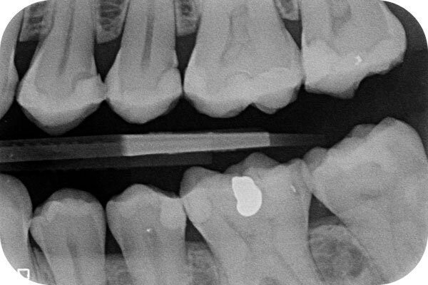 Routine Dental X-ray