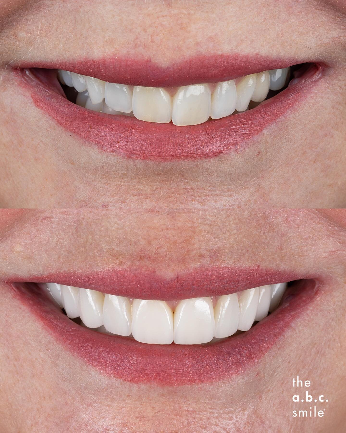 👄 Your Full Smile 👄⁣
⁣
We take you through a journey of design and discovery of what is possible in your smile with the contemporary approaches in our cosmetic dentistry.⁣
⁣
You can achieve symmetrically fuller smiles that are balanced with your li
