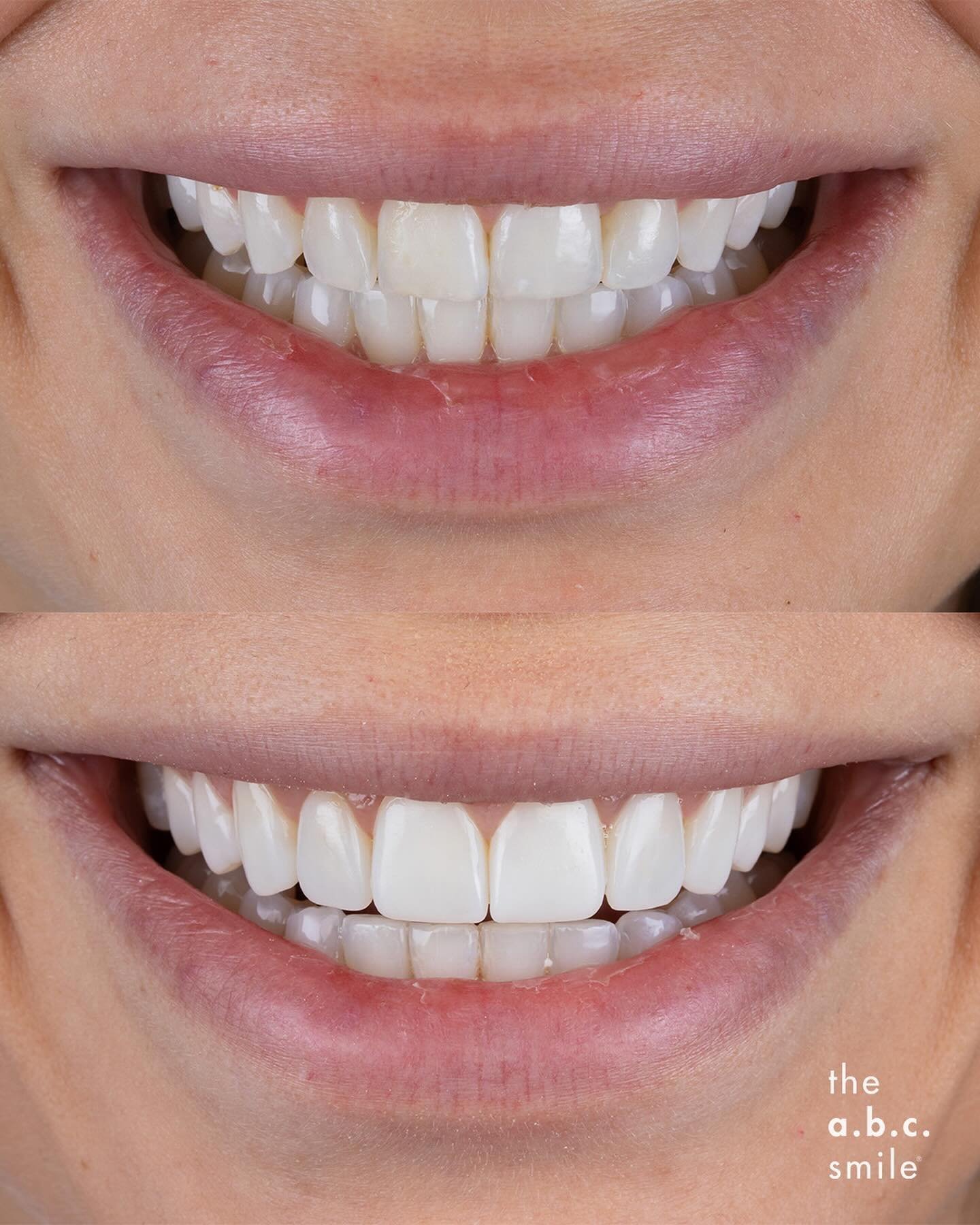 ✨ C for Contour ✨⁣
⁣⁣
The third step of our a.b.c. concept is to perfect the silhouette and surfacing of your teeth using composite to artfully sculpt and extend the visual surfaces⁣
⁣
Sometimes, it is all that is needed when you come to us with well