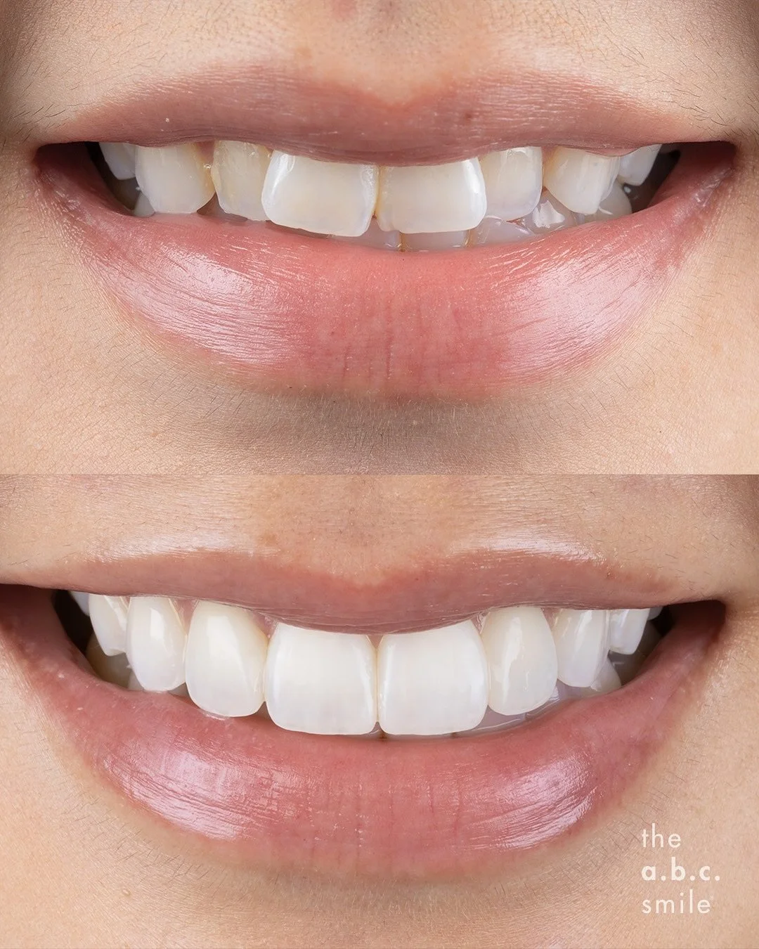 👄 this is why we a.b.c. 👄⁣
⁣
Ever since the inception of our clinic in 2017 by Dr. Edward and Dr. Tanya, the focus on the confidence-boosting results of the a.b.c. approach has provided you healthy and naturally beautiful yet perfected smiles you s