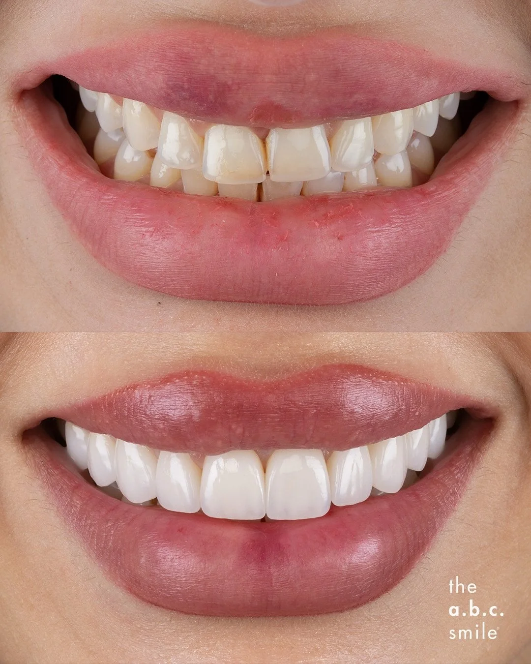 ✨ Zoom in closer ✨

Endless possibilities no matter the starting point. Achieved through our unique combination of laser gum contouring and artisanal porcelain veneers that are handcrafted for each of you.

The energy of this smile says it all 💋

#l