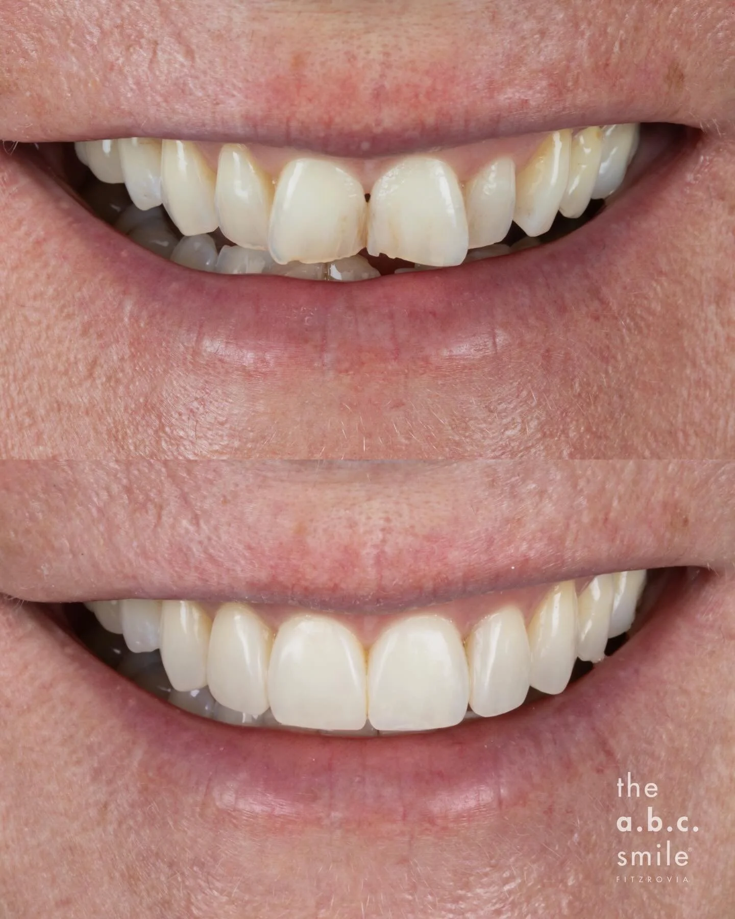 😬 full smile energy only 😬⁣⁣
⁣⁣
Our signature results achieved with the a.b.c. concept merges both health and aesthetics into one big grin!⁣⁣
⁣⁣
💛 align - clear fixed braces for 8 months⁣⁣
💛 brighten - gentle yet effective whitening⁣⁣
💛 composit