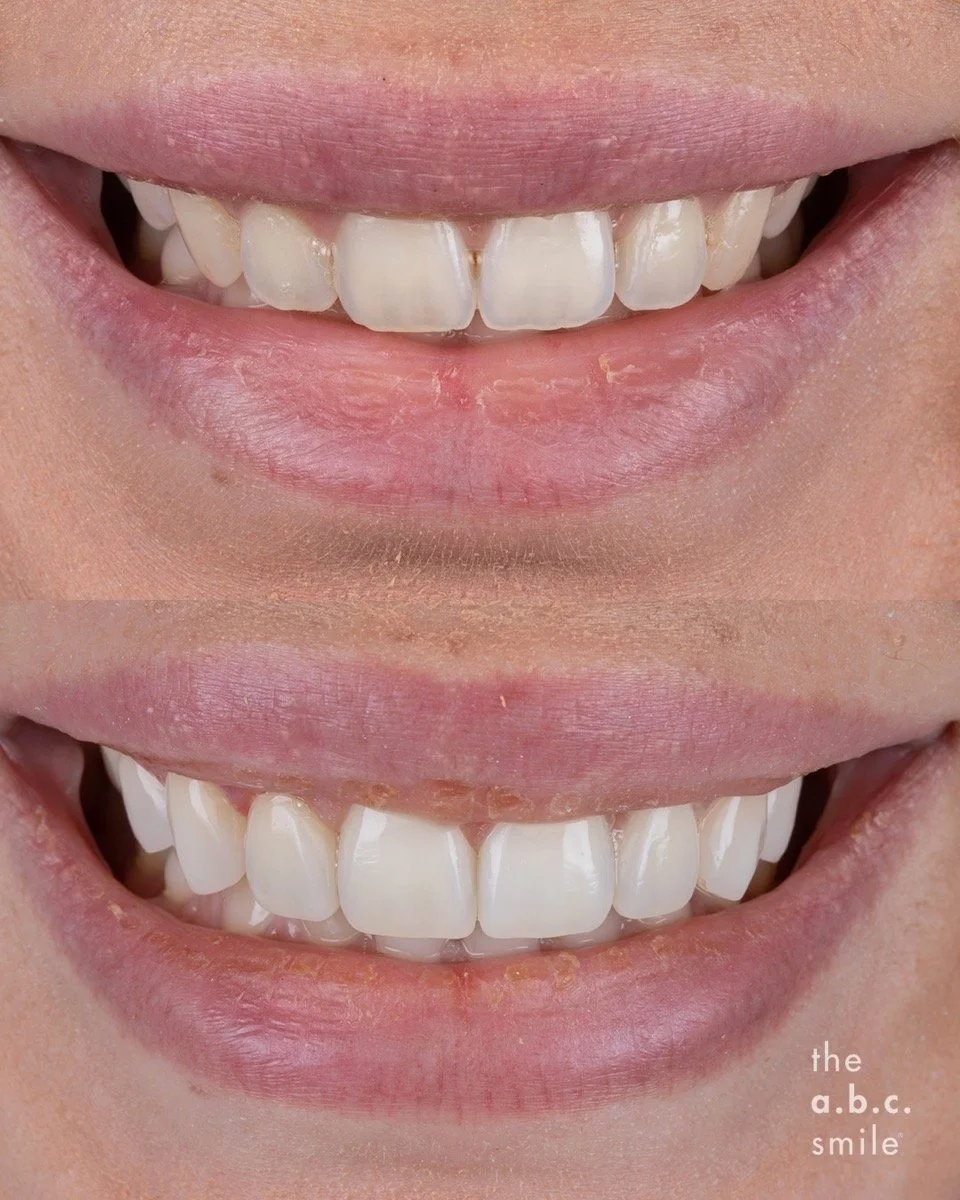 Composite Contouring Widen Smile