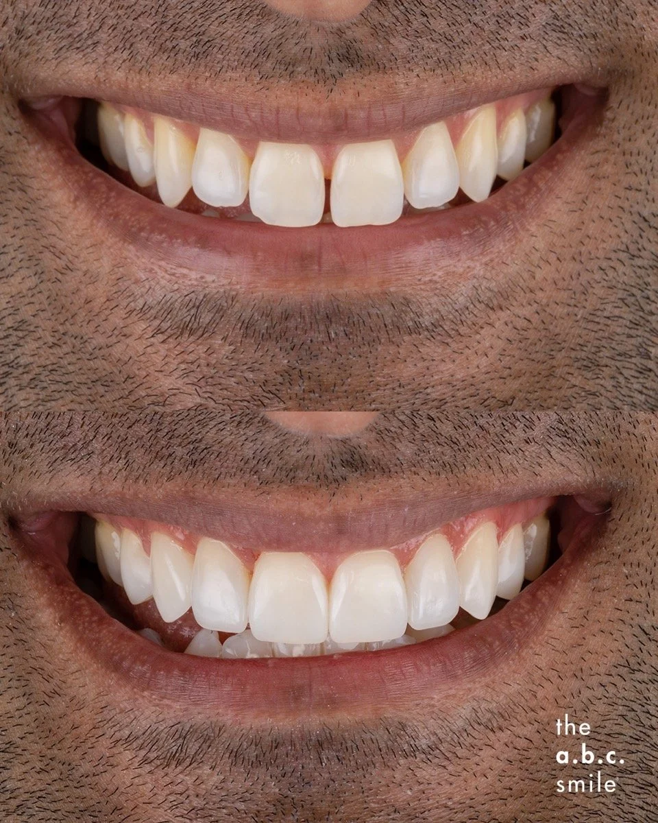 Composite Contouring Closing Gap