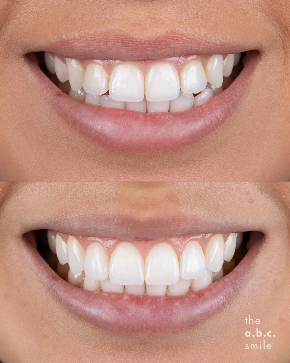 Gum & Composite Contouring