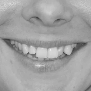 crooked-teeth.jpg