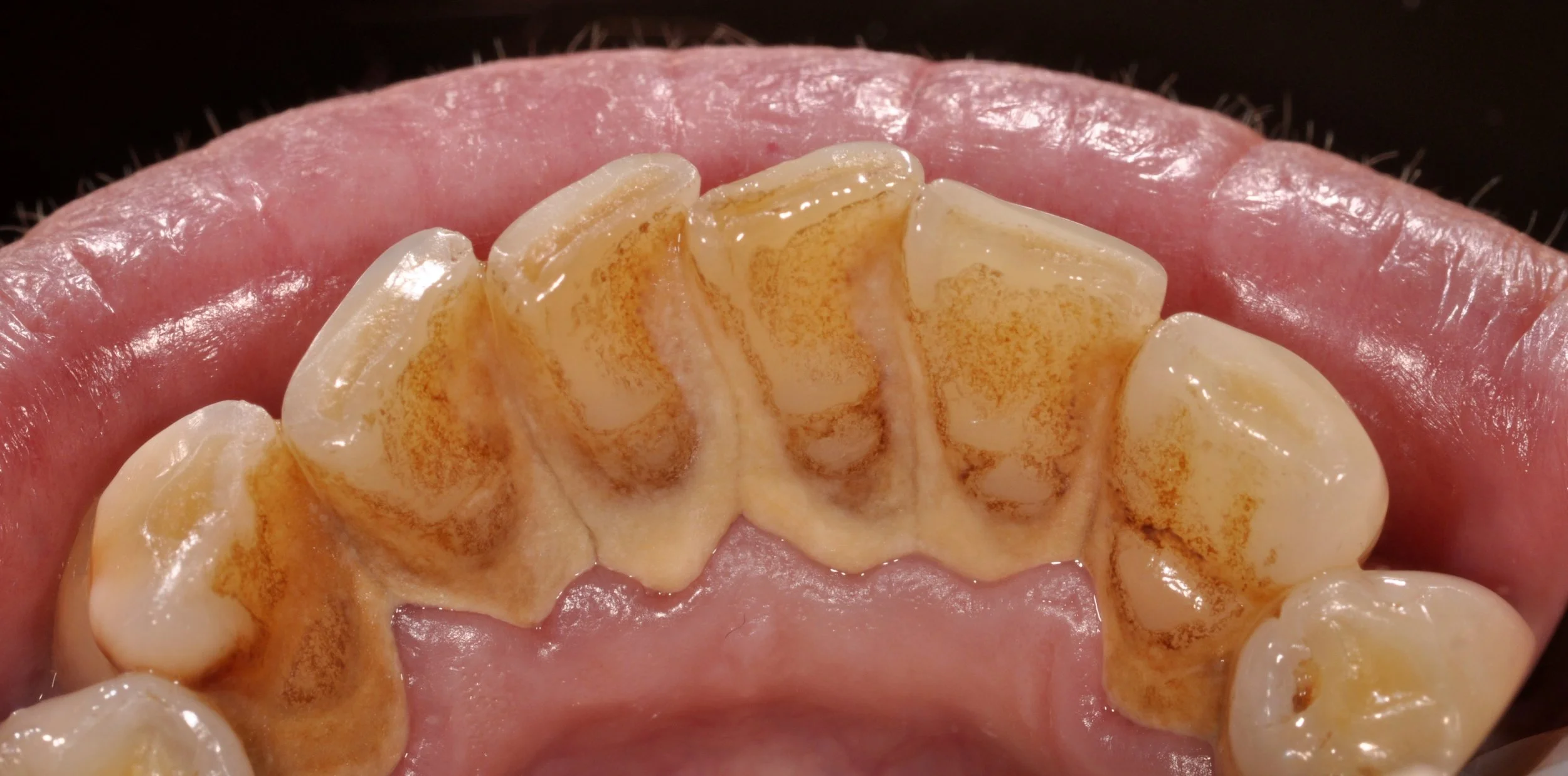 Delayed Hygiene Visit
